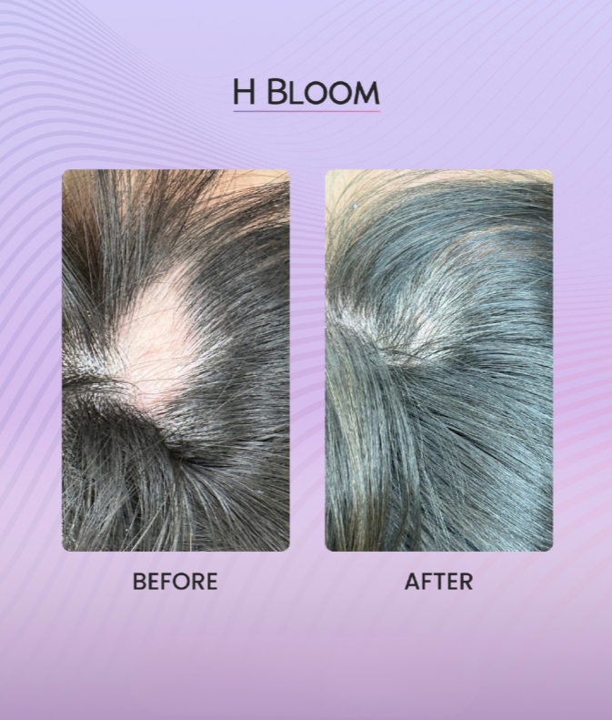 H Bloom 2 syringes/1ml - Image 4